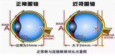 近视眼球突出？！控制近视度数加深是关键！