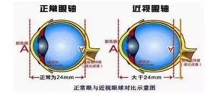 【专家解析】近视后眼球突出怎么办