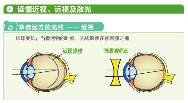 【图文详解】带您“看透”近视远视及散光