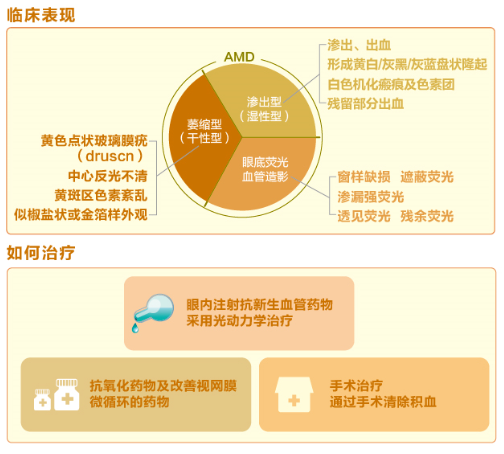 【看图解】老年黄斑变性是怎么回事