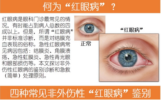 【看图解】一张图带您了解红眼病