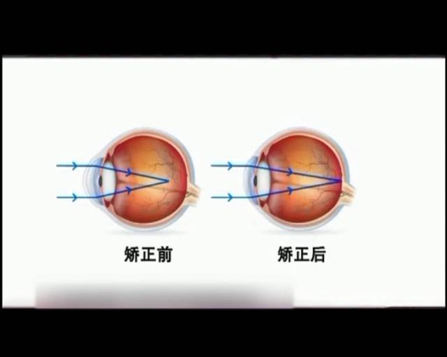 一夜之间真的能改变视力吗？