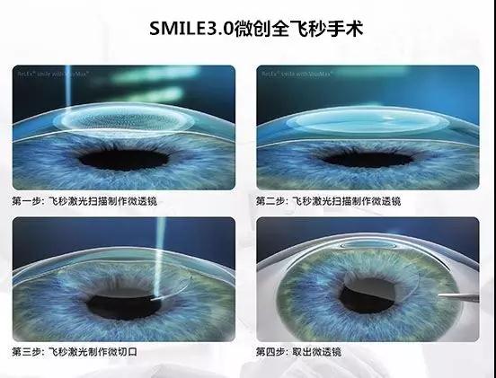 全国SMILE 之星手术视频秀决赛 武汉普瑞眼科跻身前五