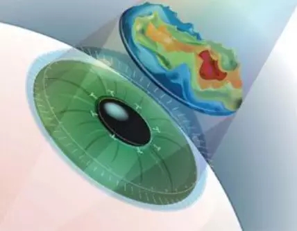 激光近视矫正和ICL晶体植入近视矫正攻略，